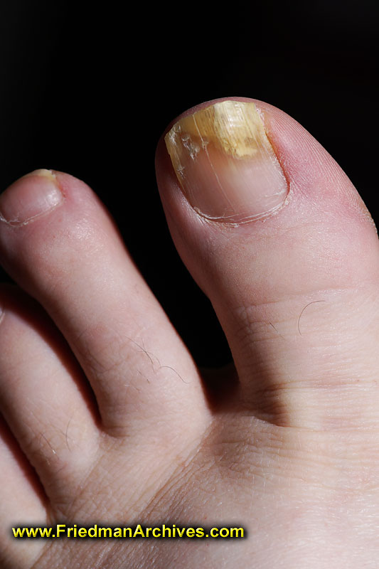 podiatrist,foot,nail,toenail,toe nail,fungus,yuck,toe,